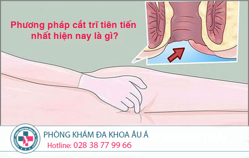 
						Các phương pháp cắt trĩ tiên tiến  hiện nay