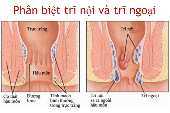 
						Phân Biệt Trĩ Nội, Trĩ Ngoại Và Cách Điều Trị Hiệu Qủa