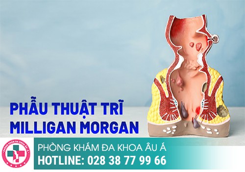 
						Xử Lý Trĩ Bằng Phương Pháp Milligan Morgan An Toàn Hồi Phục Nhanh